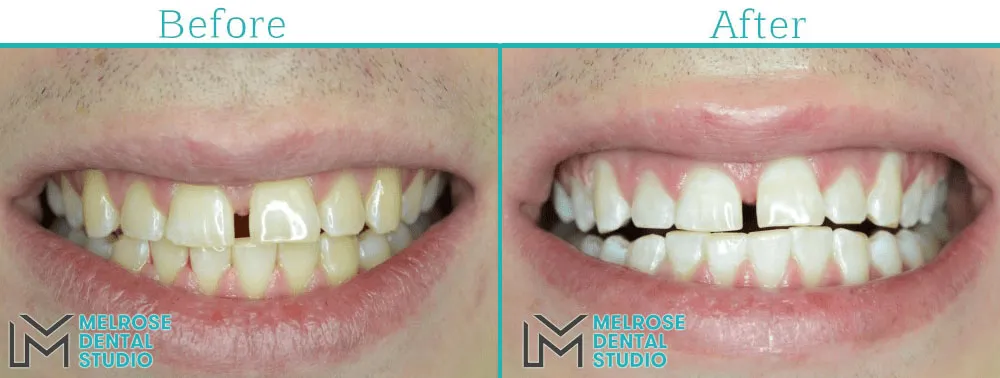Teeth whitening before and after result, case 4, Melrose Dental Studio